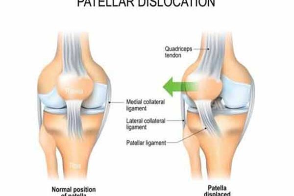 Patella-Dislocation