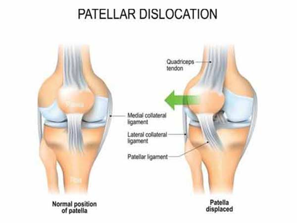 Patella-Dislocation