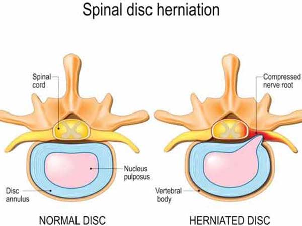 Disc-Herniation