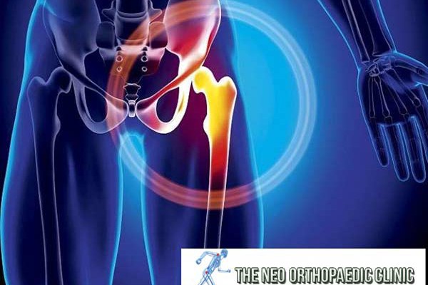 hip arthritis