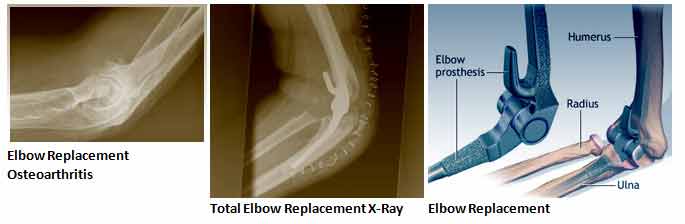 Best Elbow replacement surgery in Delhi