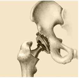 hip replacement surgery in Delhi