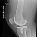 total knee replacement surgery in Delhi