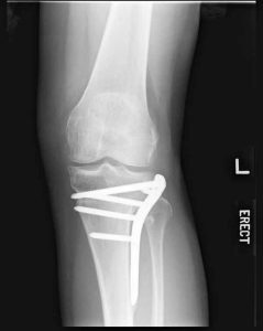 knee fracture